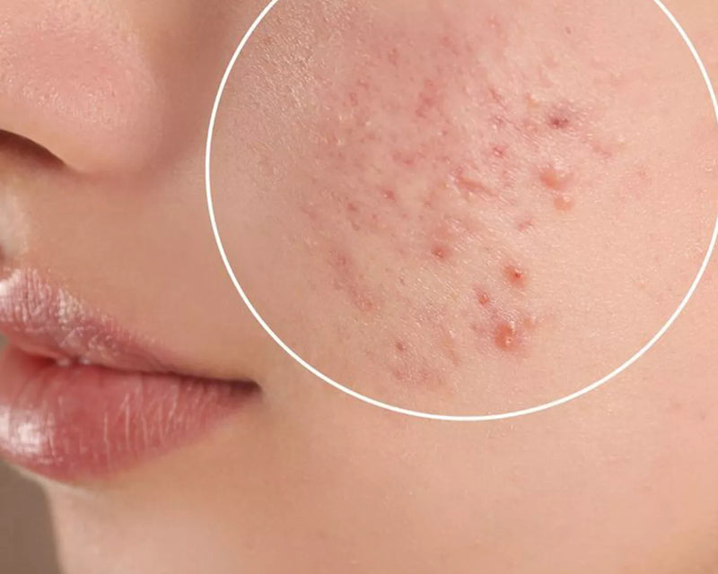 How Long Does It Take to Repair a Damaged Skin Barrier?
