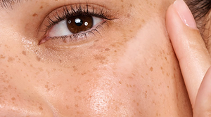 Pigment Correction